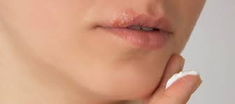 Hallo, ist herpes erst bei bläschen ansteckend oder auch schon davor, wenn man eigentlich noch nichts gemerkt hat? Herpes Behandlung Tipps Zur Schnellen Ruckbildung Von Herpes