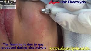 Cindy greene electrolysis is a cosmetics company located in 378 cambridge ave # d, palo alto, california, united states. Electrolysis Chin Hairs Youtube