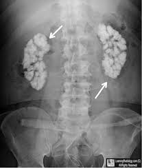 Welcome To Learningradiology Nephrocalcinosis Medullary Medullary Nephrocalcinosis Calculi Renal Stones Medullary Spo Radiology Imaging Radiology Renal