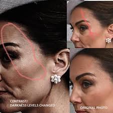 Tell me she had this scar before... : r/KateMiddletonMissing