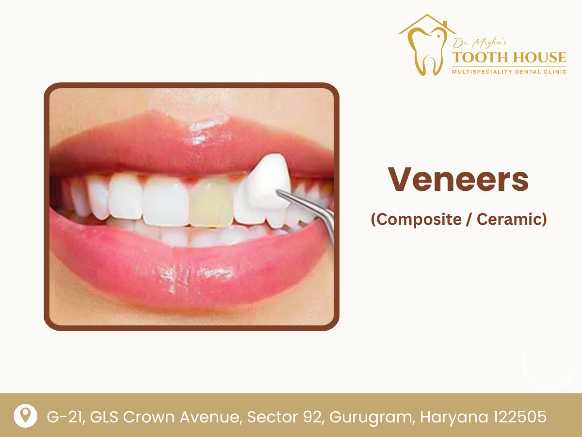 Veneers (Composite / Ceramic) product image
