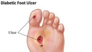 Patients who have diabetes can develop sores, usually in the lower extremities. Tips For Diabetic Foot Wound Infection And Treatment