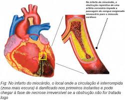 Enfarte do miocárdio instituto de medicina tradicional 1º ano curso geral de naturopatia e ciências tradicionais e holísticas elaborado por: Infarto Agudo Do Miocardio Melhor Com Saude
