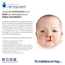 Labio y paladar hendido con el dr. Renapred Se Puede Amamantar A Un Bebe Con Labio Facebook