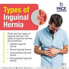 Image result for Inguinal hernia man