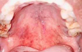 Image result for Physical injury red spots roof of mouth