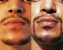 Biotin may be able to help you grow a beard, but it is unlikely to create any lasting change if you do not also modify your lifestyle and use the best products for your hair. Biotin For Beard Growth Reviews Pills Tablets Cream Side Effects Results Before And After
