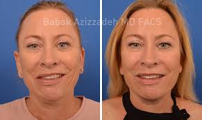 Maybe you would like to learn more about one of these? An In Depth Look At Bell S Palsy Facts And Myths