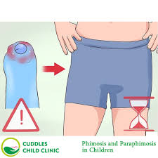 Image result for paraphimosis