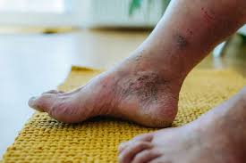 Image result for toe black diabetes