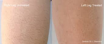 Avoid sunburns and tans for at least 2 weeks prior to treatment. Clinical Diode Laser Hair Removal Technology Diolazexl