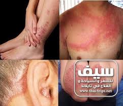 علاج مرض الصدفية مع اكبر اطباء الجلدية بتايلند وبالاتفاق مع ارقي مستشفيات تايلند