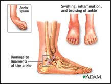 Assessment And Treatment Of Ankle Injuries Ems World