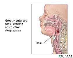 Image result for Obstructive Sleep Apnea