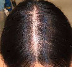When psoriasis affects your scalp, it may cause you to temporarily shed hair in certain areas of your scalp. 20f With Scalp Psoriasis I Ve Had People Mention About My Hair Thinning Since I Was 17 Or 18 I Have Noticed That My Hair Thins Where The Psoriasis Is But It Does