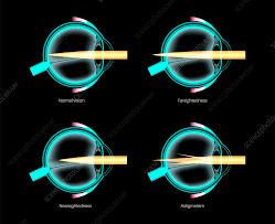 Image result for Refractive Error