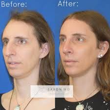 Before And After Of Facial Feminization Surgery Including A Rhinoplasty Scalp Advancement And Brow Bone Re Facial Feminization Surgery Rhinoplasty Ffs Surgery