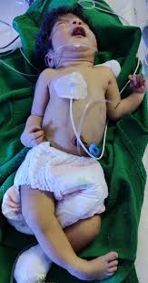 Image result for Nevus Simplex