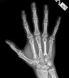 Image result for icd 10 code for right 4th metacarpal fracture