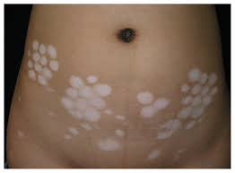 Image result for koebner phenomenon psoriasis