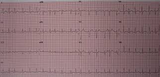 Image result for Atrial Fibrillation