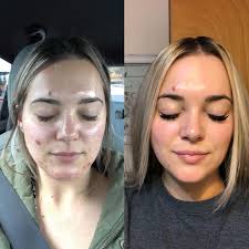 Hi! It's me! If you are new to my page, I'm glad you're here & I thought  I'd reshare a little bit of my story 🫶🏼 My skin growing up was generally