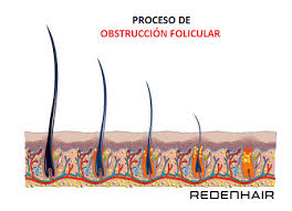 The use of hair gel on its own does not cause hair loss and in fact, you could use gel regularly for a long period of time without experiencing any negative side effects, providing you wash your hair and scalp well every day and avoid going to sleep with gel in your hair. Do The Hair Gel And Wax Cause The Hair To Fall Out