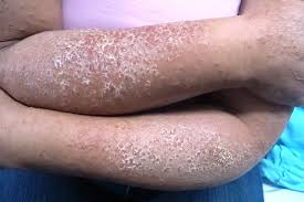 Image result for dermatitis contacta