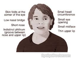 Fetal Alcohol Syndrome Fetal Alcohol Syndrome Symptoms Statistics Pictures Facts Fetal Alcohol Syndrome Fetal Alcohol Fetal Alcohol Syndrome Symptoms