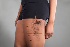 The combination of topical anesthetic + acetaminophen + meditation is an absolute game changer for how much laser tattoo removal hurts. Inkoff Me Frequently Asked Laser Tattoo Removal Questions Berkeley Ca
