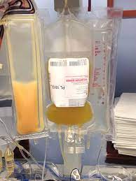 How long does a platelet donation take? Plateletpheresis Wikipedia