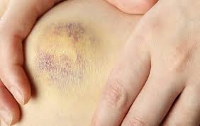 Hemofilia merupakan kelainan pada proses pembekuan darah. Memar Pada Kaki Futuready