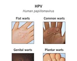 รูปภาพHuman Papillomavirus (HPV)