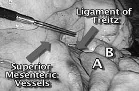 Copyright savesave ligamentum treitz for later. A Laparoscopic View Shows The Duodenum And Ligament Of Treitz As Well Download Scientific Diagram