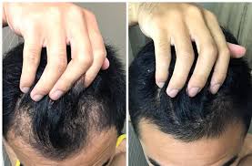 How to regrow back your hairline featuring iq jamaica black castro oil visit the links below for all products mentioned. Incredible Hairline Regrowth On Fin And Min Hair Longer On The Before Pic Hairlossprogresspics