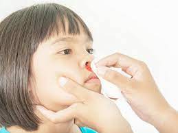 Biasanya 90% pendarahan di hidung terjadi pada bahagian hadapan yang selalunya mengaitkan dengan sebelah hidung sahaja yang mudah diberhentikan. Hidung Berdarah Cara Merawat Dan Rawatan Pendarahan Hidung