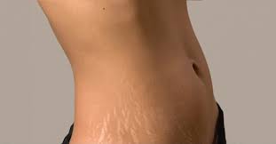 10 Remedies To Get Rid Of Stretch Mark And It Actually Works Littlethings Com