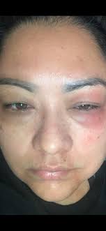 Hi everyone So I've just been to a immunologist to get a clearance for my  fish allergy however he wants me to do a “food challenge” pretty much  eating fish and seeing