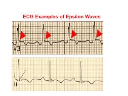 Image result for Epsilon Wave