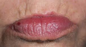 Fyi, cherry angiomas since child answered by dr. Cosmetic Colorado Center For Dermatology Skin Surgery