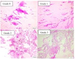TURKISH OURNAL OF OPHTHALMOLOGY