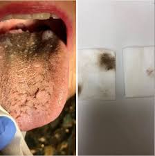 Image result for black hairy tongue symptoms