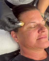 Come to @hatefaesthetics for Skinvive + PRP with the amazing Jessie  @jmadormohenry 💉✨ I wanted to smooth my smile lines and add glow to my  cheeks — mission accomplished 🙌 Skinvive boosted