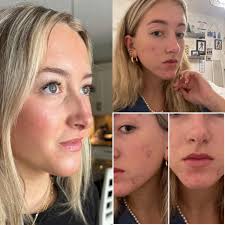 I was having bad skin 😩 people use to gossip abt my face, bt one day this  lady come to Me recommending LANI SKIN CARE to try, after a week my face