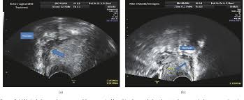 Pdf Daily Vaginal Application Of Dienogest Visanne C For 3 Months In Symptomatic Deeply Infiltrating Rectovaginal Endometriosis A Possible New Treatment Approach Semantic Scholar