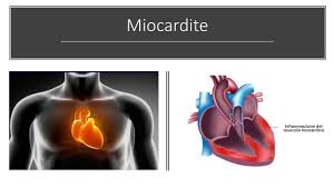 La miocardite è un'infiammazione del muscolo cardiaco in genere associata a infezioni virali, batteriche o fungine (o micotiche). Cos E La Miocardite E Come Si Cura
