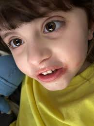 Alternative lip care for dry winter lips