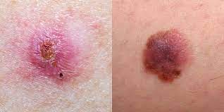 If you've received a diagnosis, here are some things you need to know about the condition. Skin Cancer Pictures 5 Different Types Of Skin Cancer To Know