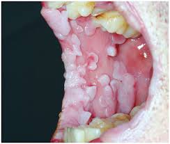 Image result for papillomavirus tongue)