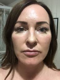 Why chin's are the new lips